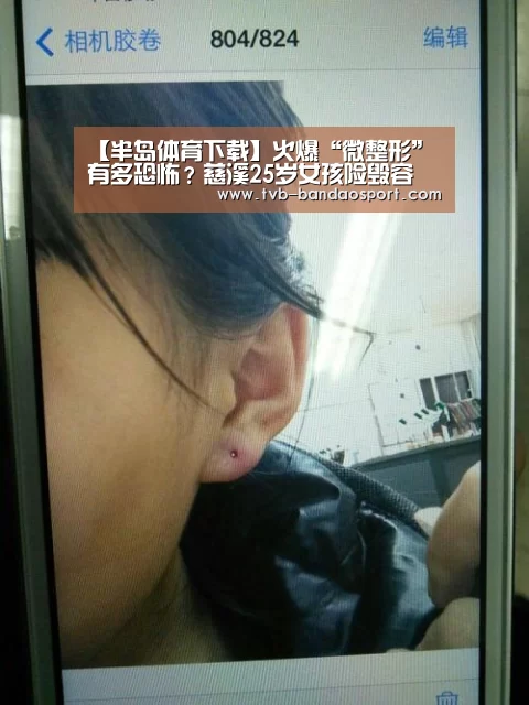 【半岛体育下载】火爆“微整形”有多恐怖?慈溪25岁女孩险毁容(图2) 半岛体育官网